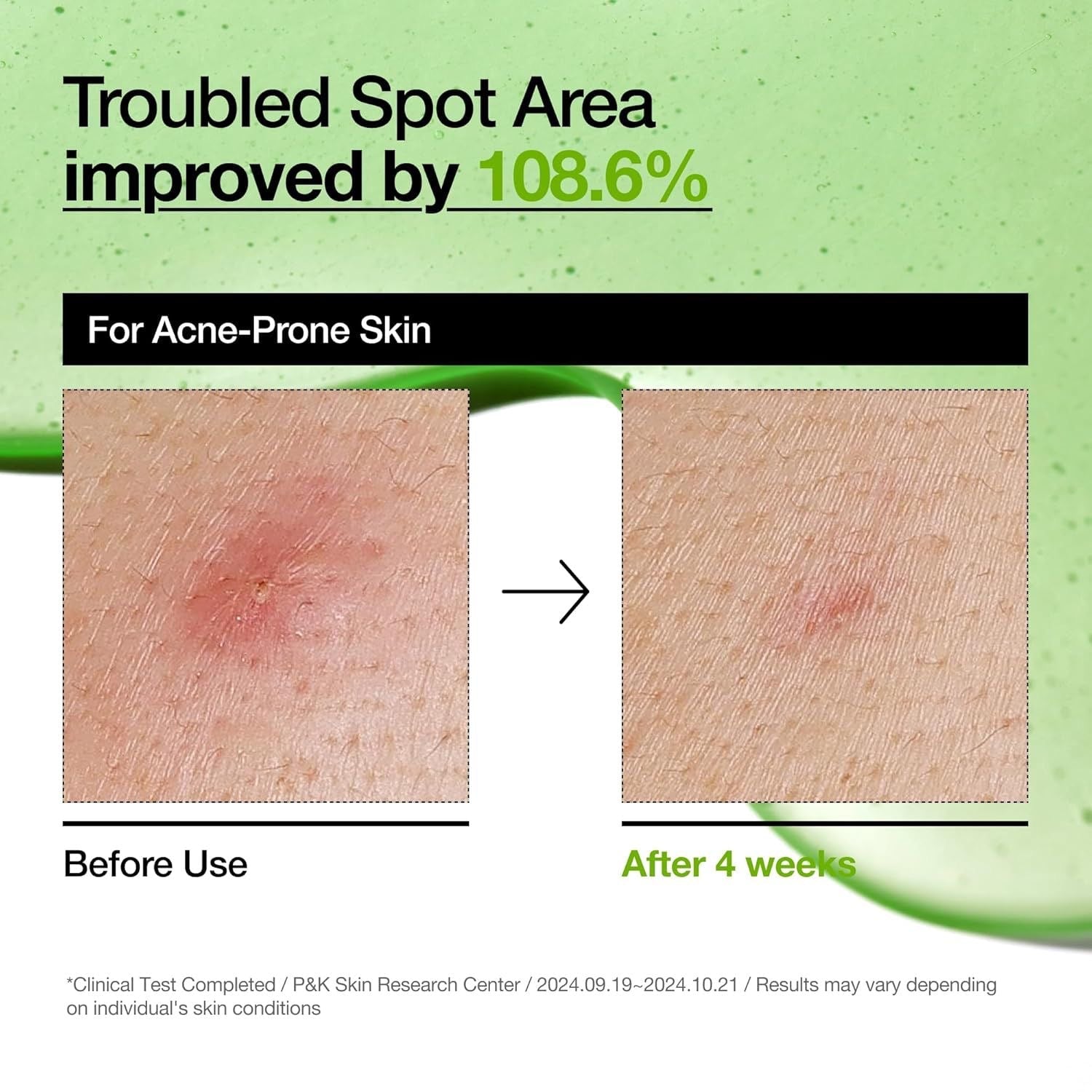 ANUA Azelaic Acid 10% Hyaluron Redness Soothing Serum 30ml - Baresoul